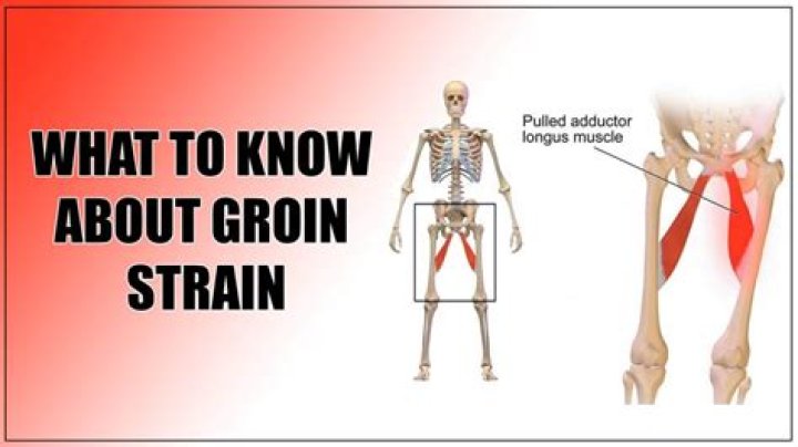 Can you get a muscle knot in your groin?
