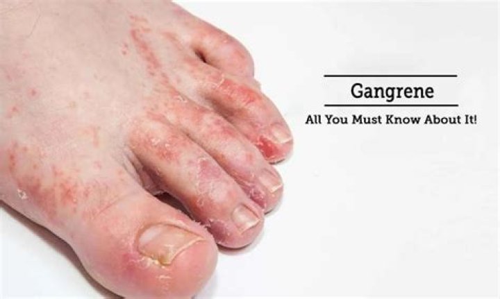 How do you get gangrene in your balls?