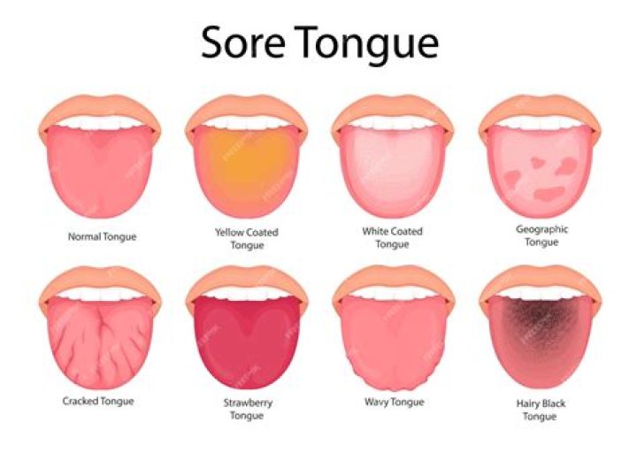 How do you get rid of a sour candy tongue burn?