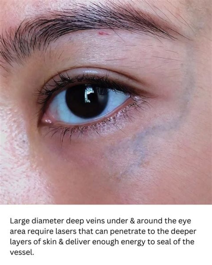Is a burst vein dangerous?