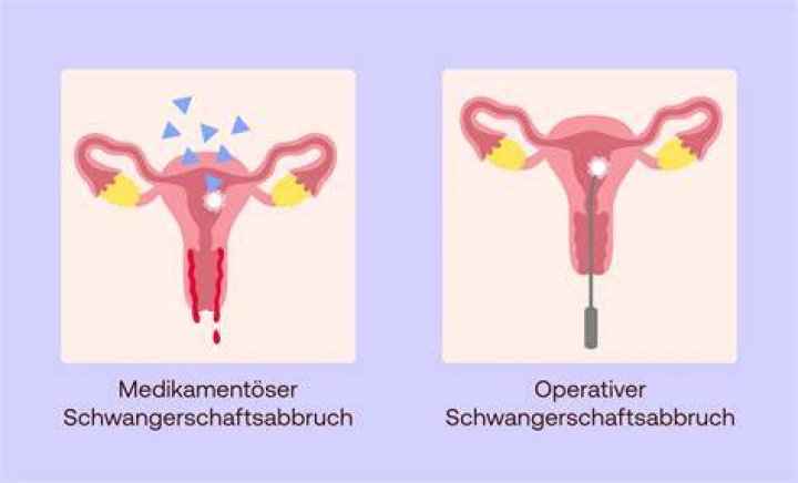 Kann man nach Ausschabung direkt wieder schwanger werden?