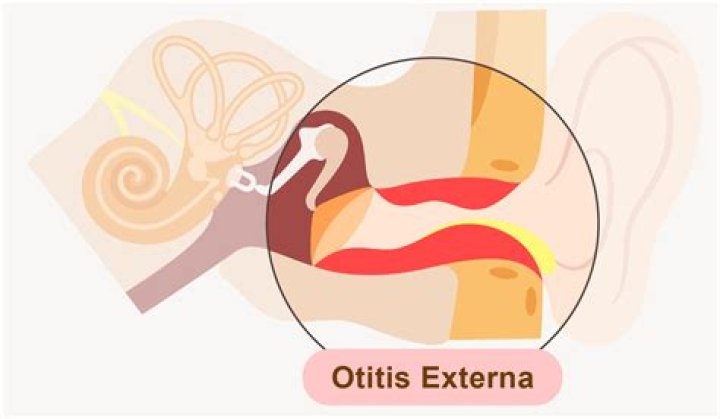 What's the code for otitis externa of the left ear?
