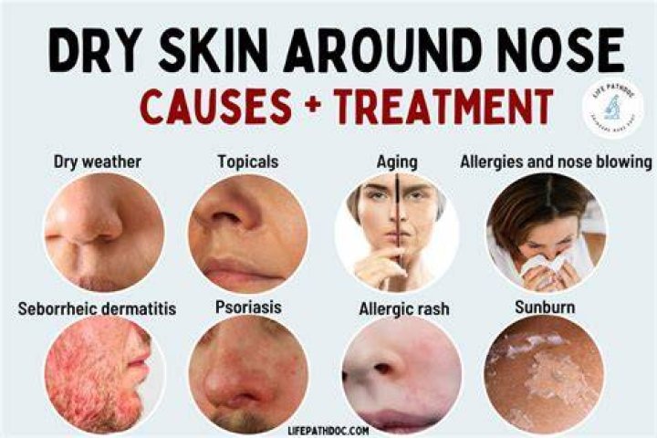 What causes sores on tip of nose?