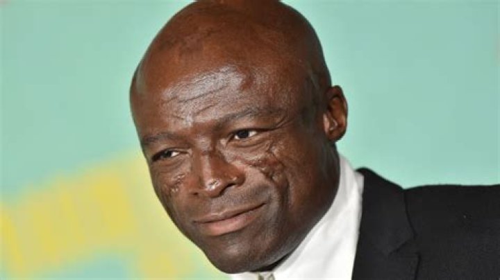 What happened to seals the singer's face?