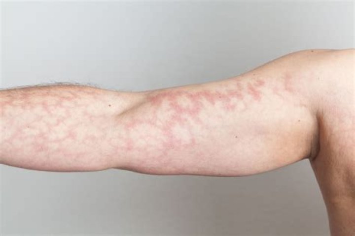 What is the meaning of blotches?
