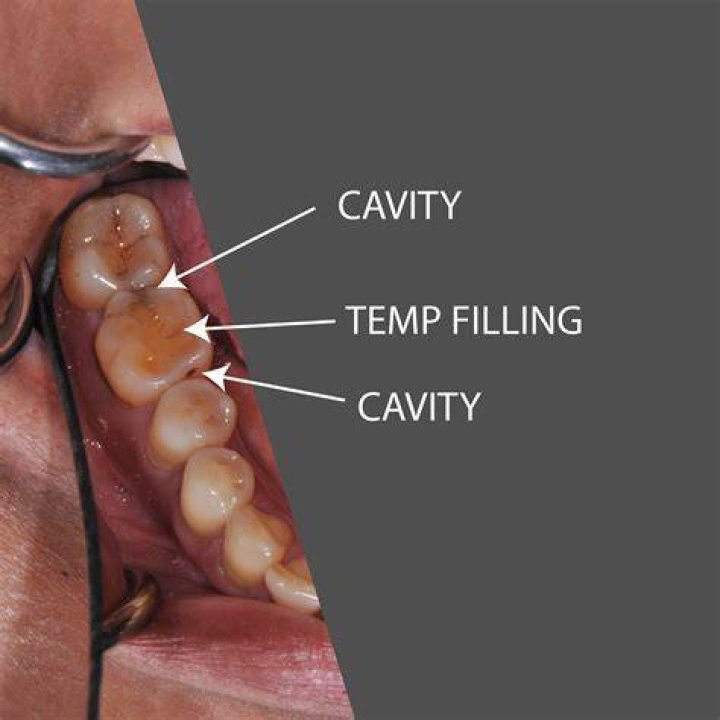 Why do I taste my fillings?
