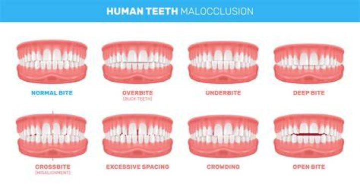 Why do my teeth feel like they are moving?